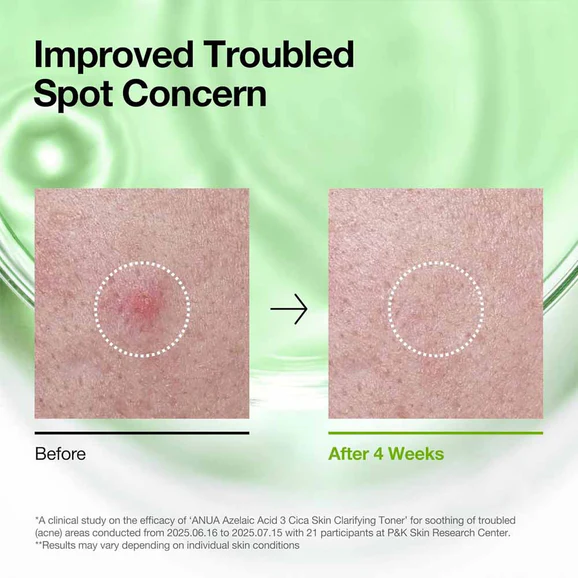 Anua Azelaic Acid 3 Cica Skin Clarifying Toner - Image 4